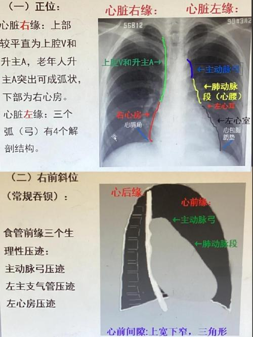 原发性肺动脉高压 特发性费用脉高压