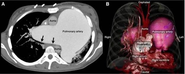 原发性肺动脉高压 特发性费用脉高压