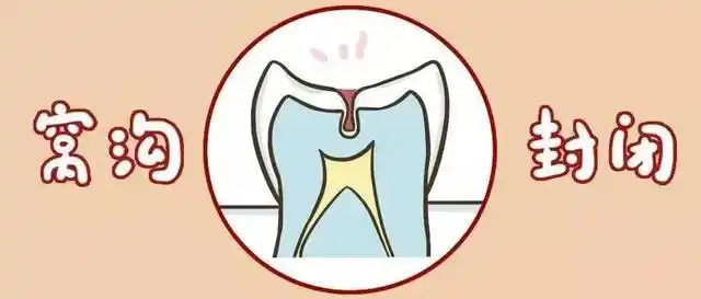 儿童窝沟封闭知识