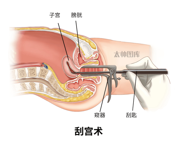 人流术前消毒步骤