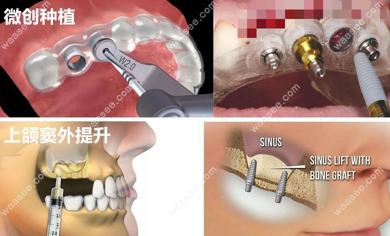 现在做种植牙都是微创技术治疗吗?是的,请看微创种植牙视频
