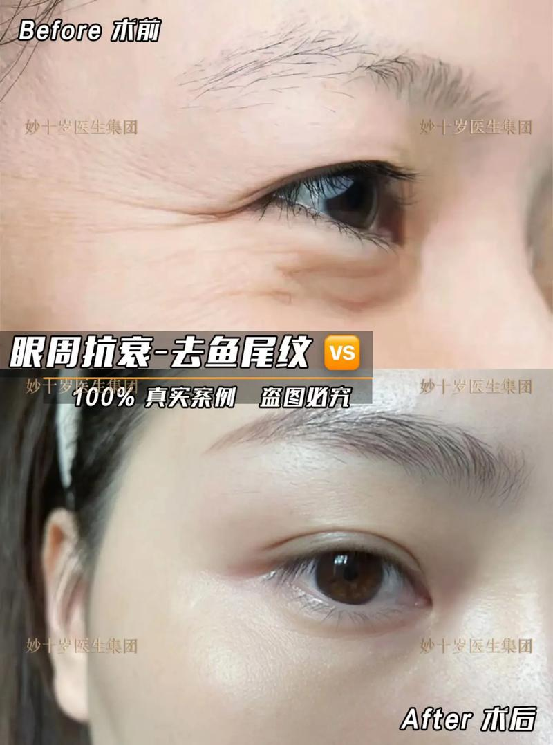 Eyebrowtail removal method