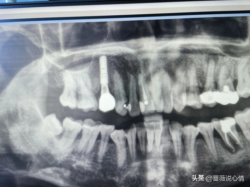 口腔根管治疗的步骤