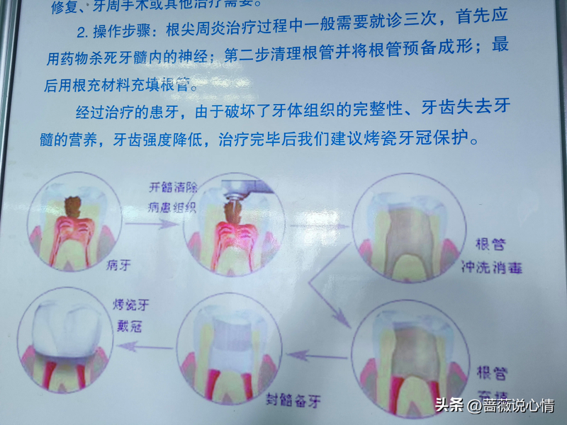 口腔根管治疗的步骤