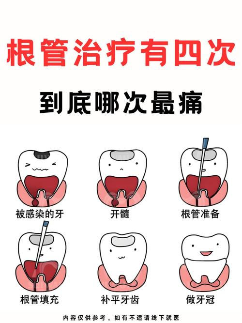 口腔根管治疗的步骤