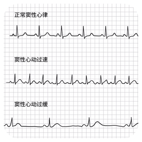 窦性心律心电图特点