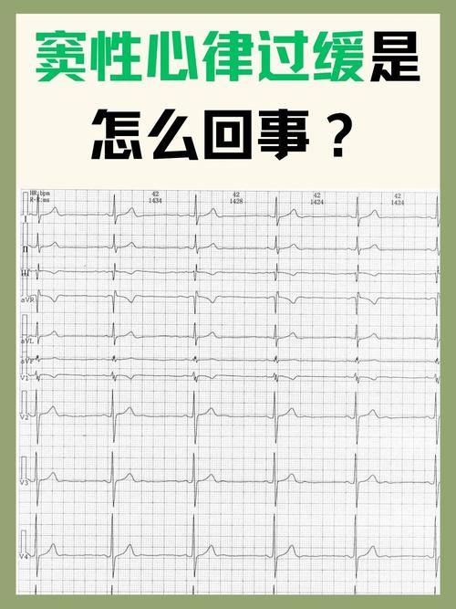 窦性心律心电图特点