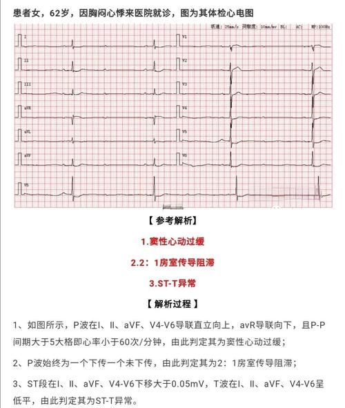 窦性心律心电图特点
