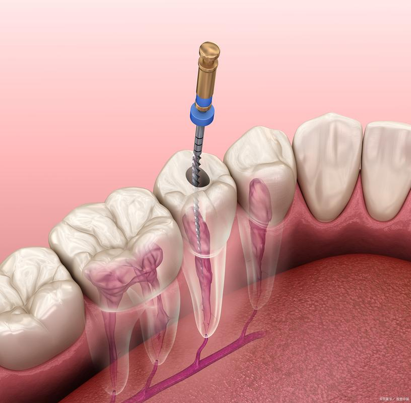 Steps for oral root tube treatment