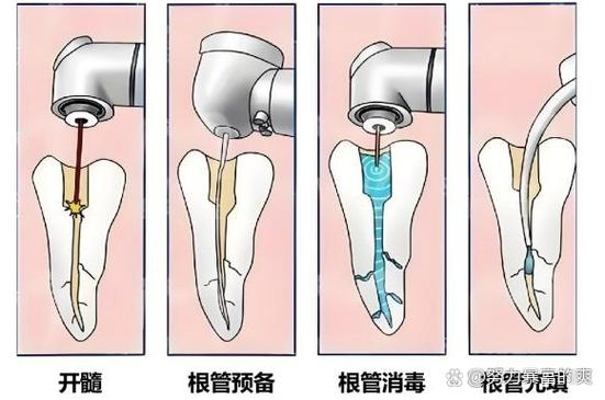Steps for oral root tube treatment