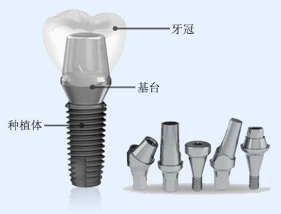 口腔根管治疗的步骤