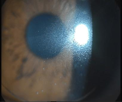 The working principles of near-sighted glasses