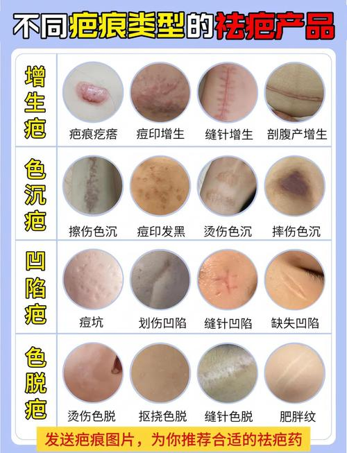 ffs疤痕种植技术