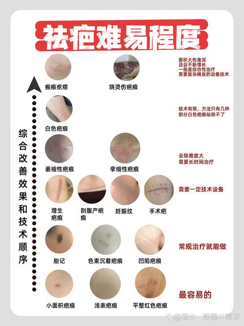 ffs疤痕种植技术