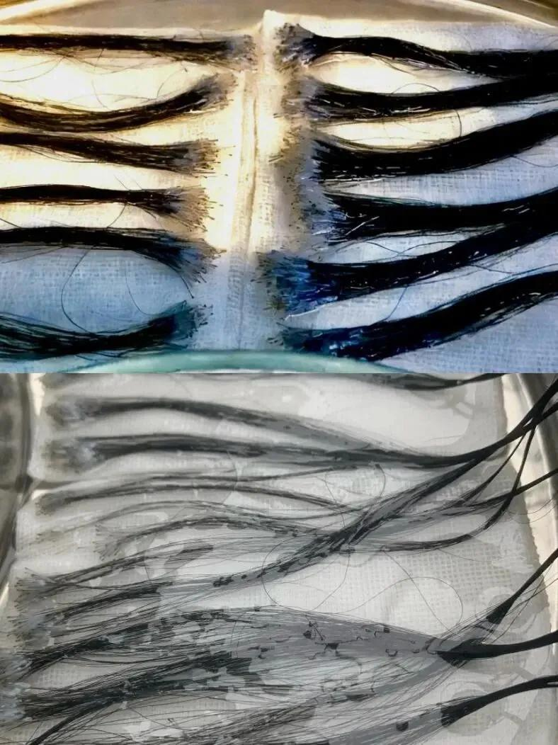 ffs疤痕种植技术