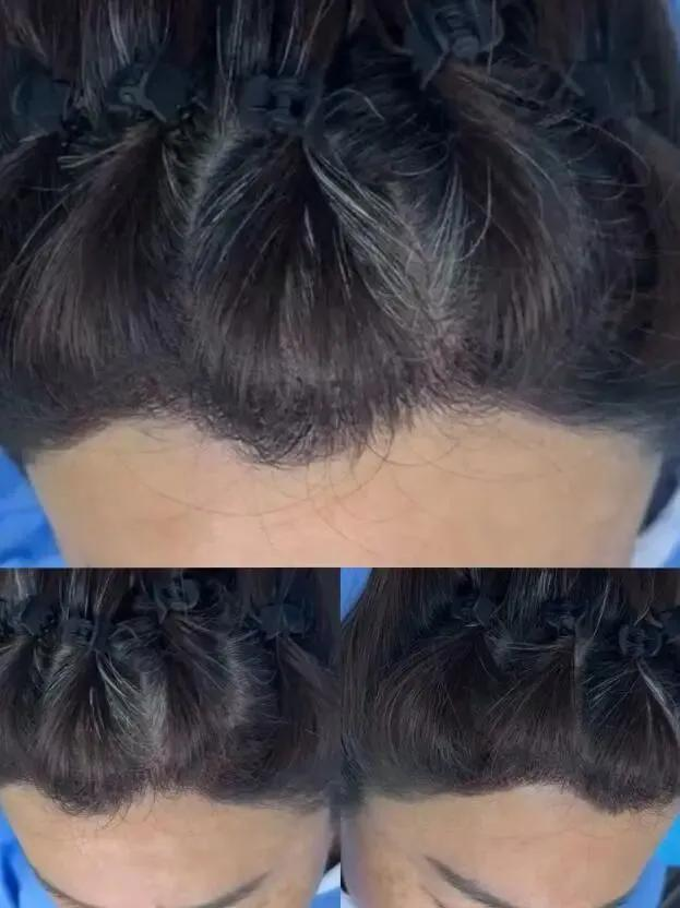 ffs疤痕种植技术