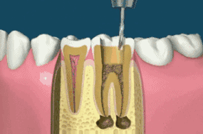 Steps for oral root tube treatment