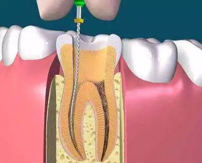 Steps for oral root tube treatment