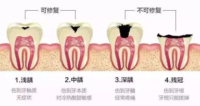 Steps for oral root tube treatment
