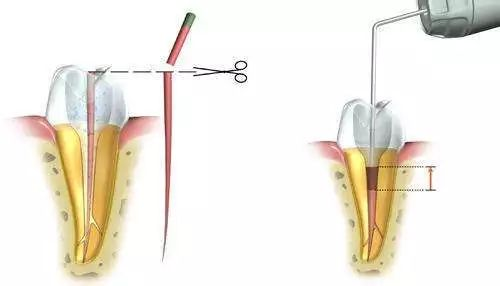 Steps for oral root tube treatment