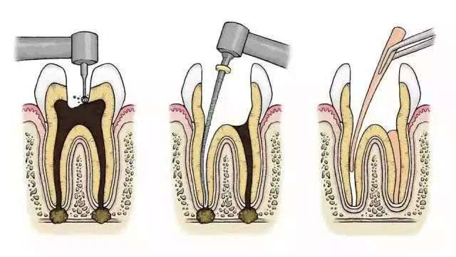 Steps for oral root tube treatment