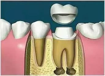 Steps for oral root tube treatment