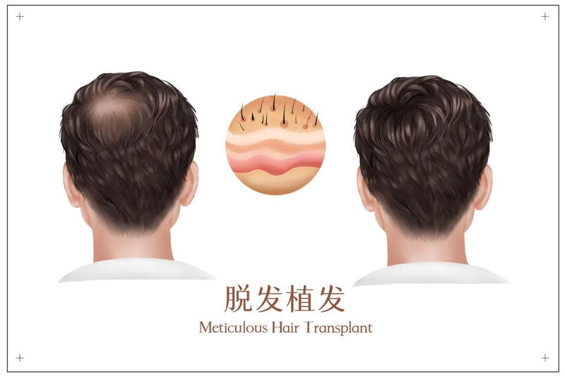 ffs疤痕种植技术