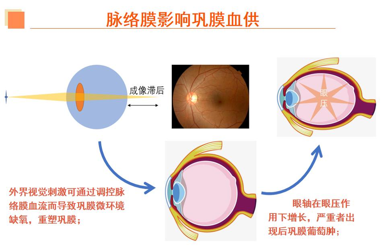 近视眼镜工作原理