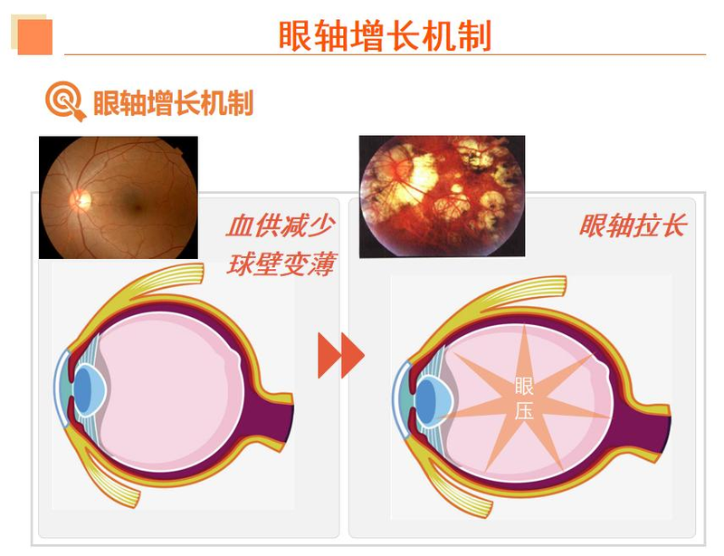 近视眼镜工作原理