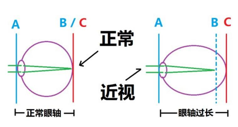 近视眼镜工作原理