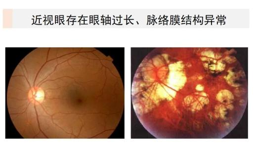 近视眼镜工作原理