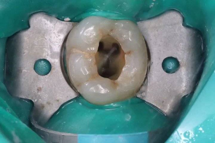 口腔根管治疗的步骤