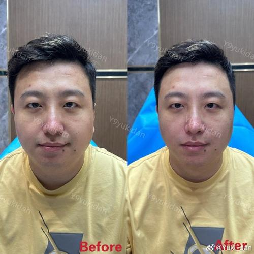 Price of thin face needles