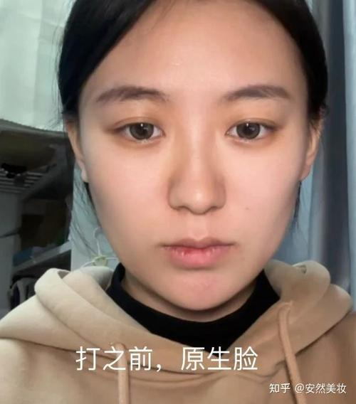 注射瘦脸针价格