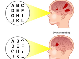 儿童自闭症的成因