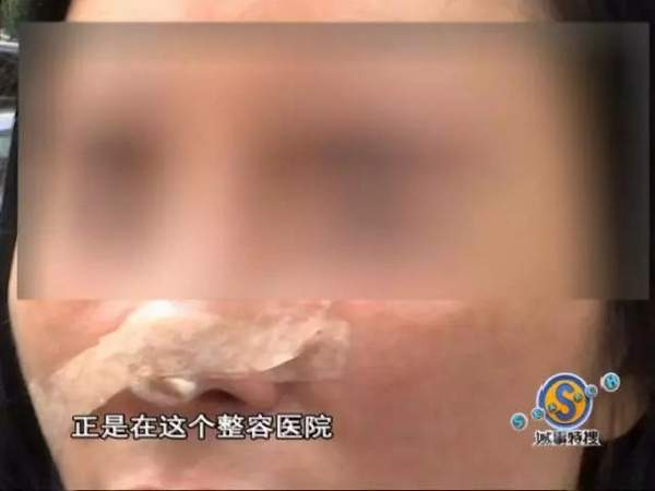 垫下巴假体费用