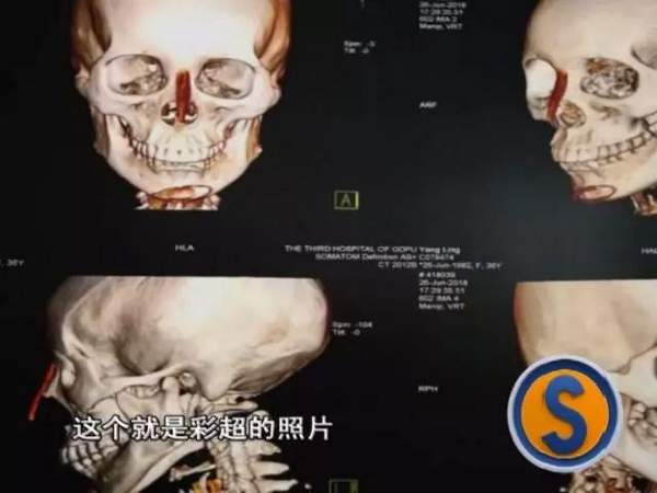 垫下巴假体费用