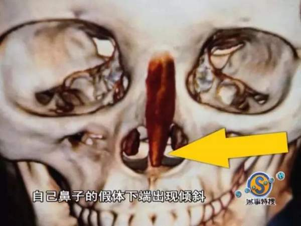 垫下巴假体费用