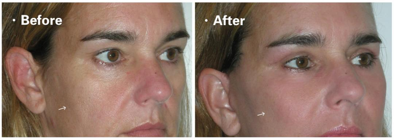 垫下巴假体费用