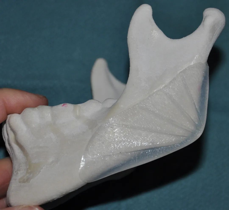 垫下巴假体费用