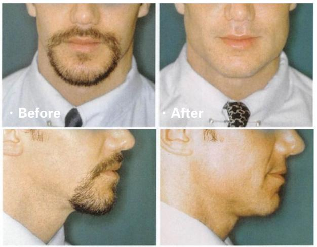 垫下巴假体费用