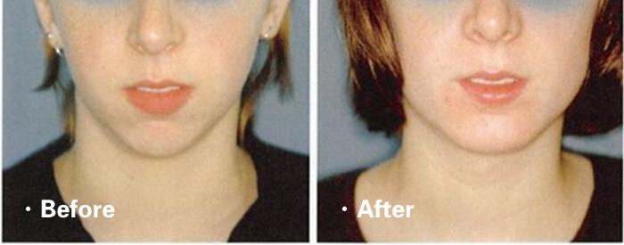 垫下巴假体费用