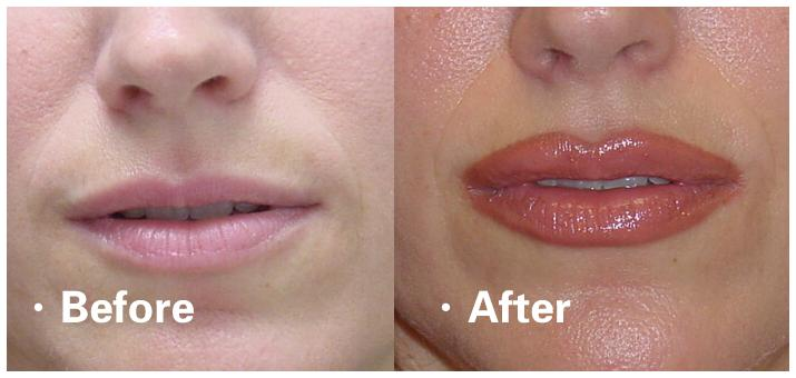 垫下巴假体费用