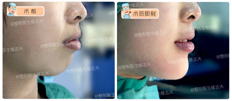 垫下巴假体费用