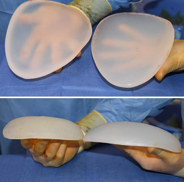 垫下巴假体费用