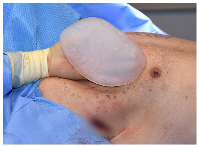 垫下巴假体费用