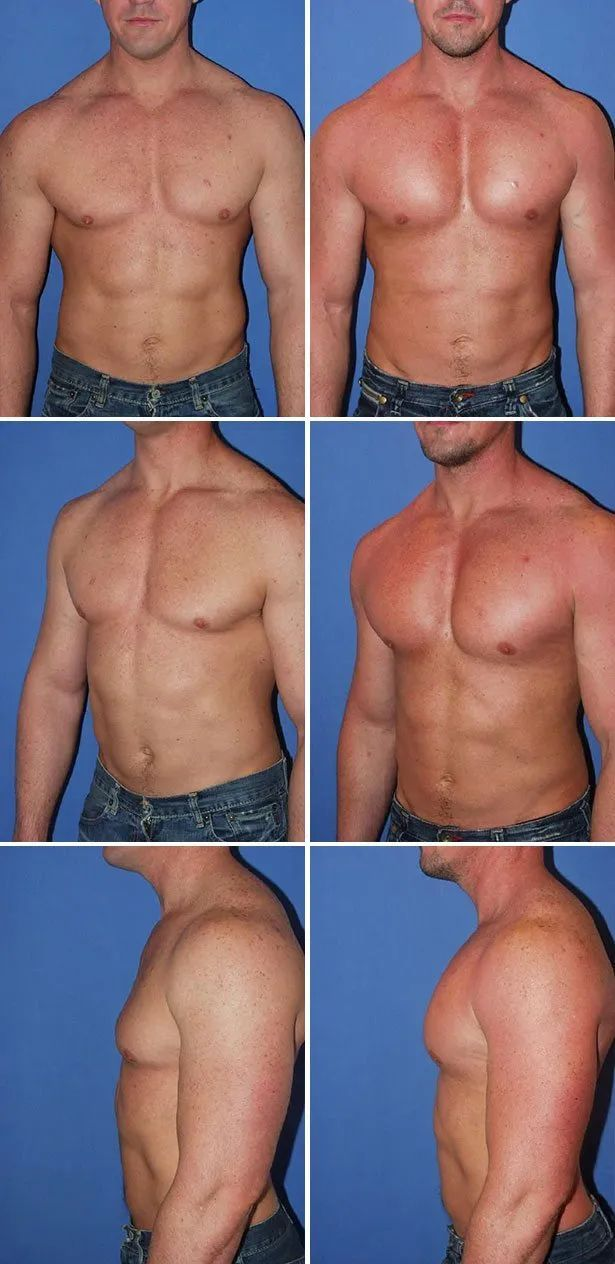 垫下巴假体费用