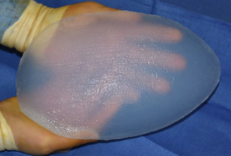 垫下巴假体费用