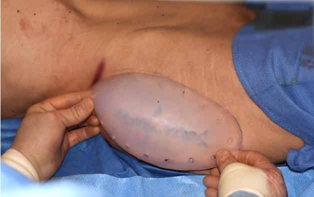 垫下巴假体费用