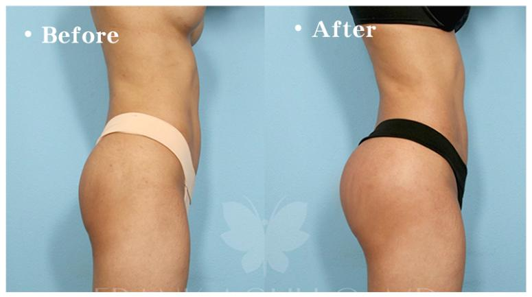 垫下巴假体费用